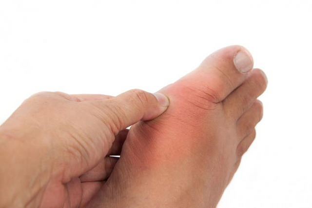 أسباب و أعراض و علاج داء النقرس و أهم الأساليب الوقائية من المرض